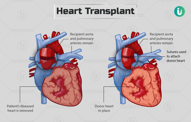 Heart Transplant Diagram Heart Transplant Diagram