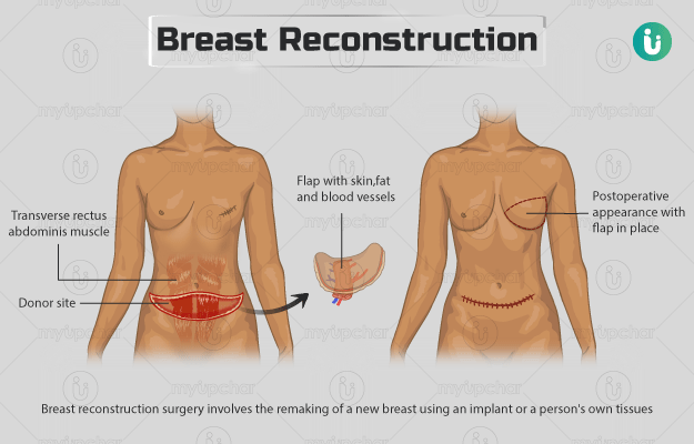 reconstruction of a breast