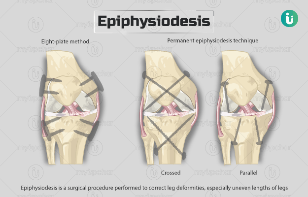 Epiphysiodesis Procedure Purpose Results Cost Price Indications 