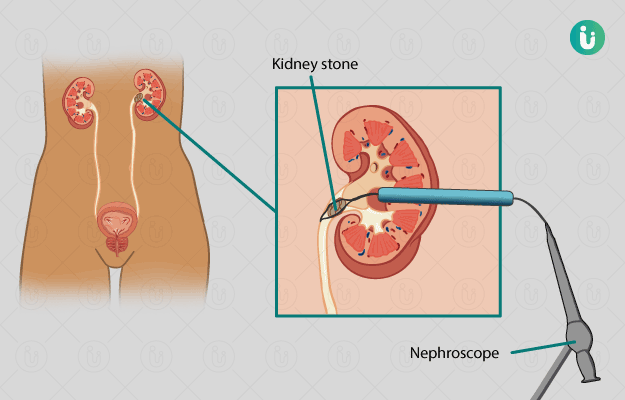 Percutaneous Nephrolithotomy PCNL Procedure Purpose Results Cost 